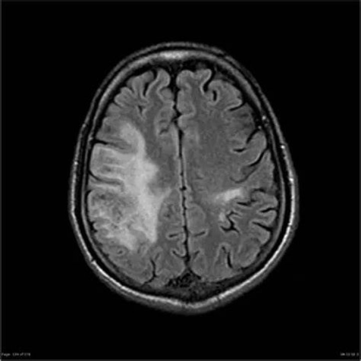 Understanding Acute Toxic Progressive Leukoencephalopathy: Symptoms, Causes, and Treatment